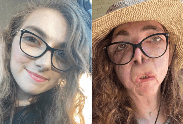 Woman Shares Raw Update Four Years After Dog Attack Tore Off Her Face